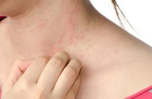 what does aundry detergent rash look like